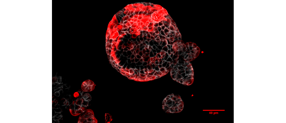 Colorectal cancer organoid with residual cells responsible for relapse marked in red. (IRB Barcelona) Colorectal cancer organoid with residual cells responsible for relapse marked in red. (IRB Barcelona)